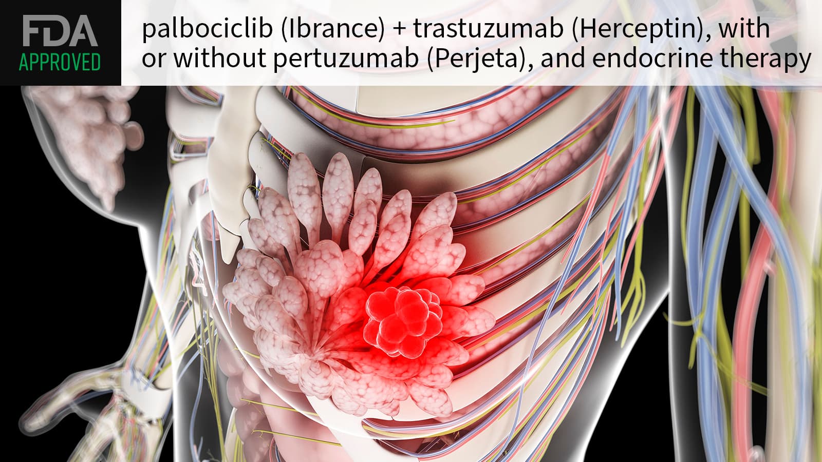 FDA Approves CDK4/6 Inhibitor for HER2-Positive Breast Cancer